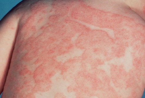 allergic reaction rash. and a raised rash,