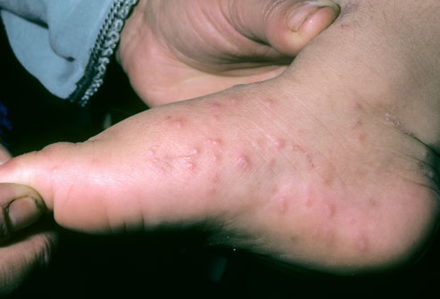 heat rash on hands. Hand-foot-mouth disease