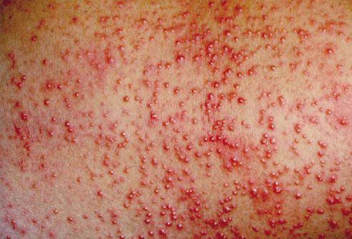 poison ivy rash pictures. heat rash looks like small